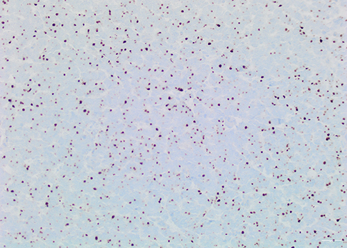 Figure 3 Tumor cells show positive, dot-like, staining for cytokeratin 20. (Immunohistochemical stain, original magnification x20).