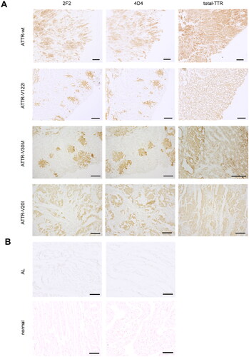 Figure 4. Immunolabeling of cardiac tissue from patients with hereditary and sporadic ATTR amyloidosis. (A) 2F2 and 4D4 antibodies specifically label amyloid TTR deposits in various ATTR amyloidosis cases (wild-type, V30M, V122I, V20I) in contrast to staining of the polyclonal total-TTR antibody. (B) No 2F2 or 4D4 immunolabeling was observed in cardiac tissue from cardiomyopathy patients with AL amyloidosis (AL) or healthy individuals (normal). Scale bar = 200 µm.