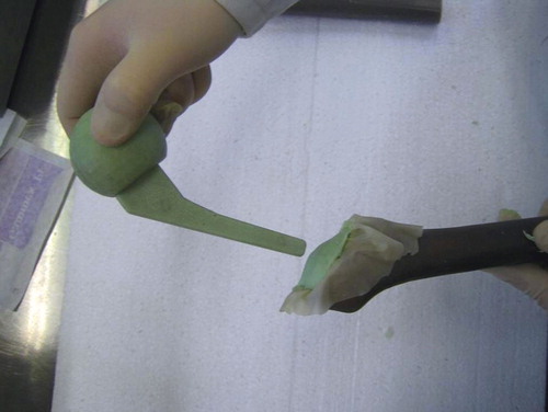 Figure 4. Insertion of the hip spacer into the cement-filled glove.