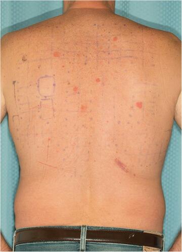 Figure 1 Patient showing positive reactions at several application sites of distinct allergens, following the removal of patches.