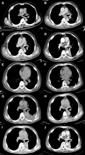 Figure 2 (A) Baseline CT Scan at diagnosis in Jan, 2013. (B) PD on chemotherapy in Aug, 2014. (C) PR after icotinib treatment in Feb, 2015. (D) PD on icotinib in Dec, 2015. (E) PR after osimertinib treatment in Sep, 2016. (F) PD on osimertinib in Dec, 2017. (G) PD on chemotherapy in Apr, 2018. (H) PR after the combined treatment of afatinib and apatinib in Nov, 2018. (I) PD on afatinib combined with apatinib treatment in Feb, 2019. (J) PR on albumin-bound paclitaxel and toripalimab treatment in Jul, 2019.