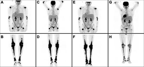 Figure 2 Serial follow-up with Maximum Intensity Projection Whole Body Positron Emission Tomography. (A, B) Initial staging at ECD diagnosis with extensive metabolically active disease; (C, D) progressive metabolically active disease after 1 year treatment with INF-a; (E, F) stable metabolically active disease following induction chemotherapy with two cycles of Ara-C and idarubicin plus midostaurin, and (G, H) metabolic response with significant improvement of the previous PET findings 6 months following the initiation of consolidation therapy with three cycles of HiDAC plus midostaurin following maintenance with midostaurin.