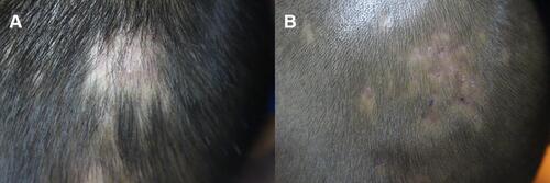 Figure 1 (A) Clinical manifestation of patient 1. (B) Complete remission after treatment of patient 1.