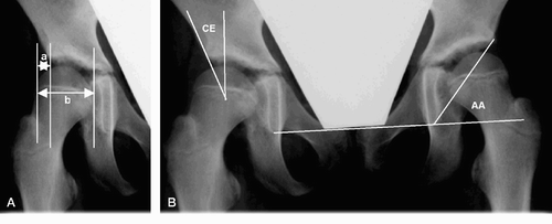 Figure 2. Radiograph of the same patient as in Figure 1 at the age of 9 years. Migration percentage (panel A) is a/b × 100 and indicates the percentage of the femoral epiphysis lateral to the lateral rim of the acetabulum. CE is center-edge angle and AA is acetabular angle (panel B)