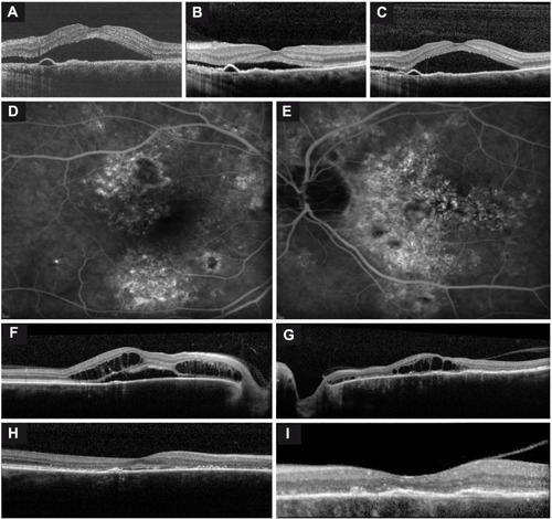 Figure 1 Imaging of two chronic central serous chorioretinopathy (cCSC) patients.