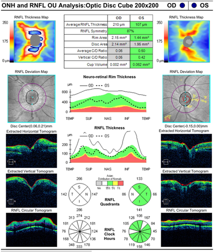 Figure 4 OCT of the ONH in the RE and LE was conducted. The optical coherence tomography (OCT) of the optic nerve head revealed that the analysis of the retinal nerve fiber layer showed 360° optic nerve edema in the right eye, while no optic nerve edema was detected in the left eye, with a small crowded cup-to-disc ratio (CDR).