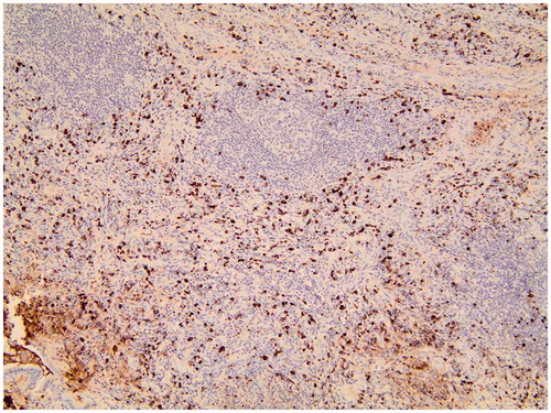 Figure 2. The lung tissue biopsied before lymphoma diagnosis shows dense lymphoplasmacytic infiltration rich in IgG4 + plasma cells, germinal center, and storiform fibrosis (magnification ×100).
