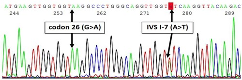 Figure 2. Sanger sequencing revealed in cis interaction of IVS I-7 (A > T) (β+) and codon 26 (G > A) (βE) coinherited with in trans codon 26 (G > A) (βE).