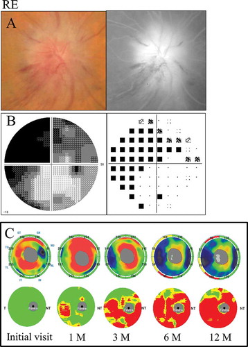 Figure 5. A 72-year-old male with diffuse visual field loss that was more dense superiorly (case 5). (A) Left: a fundus photograph showed severe optic disc swelling with splinter haemorrhage; Right: FA images showed the leakage of the optic disc and a filling delay in the inferior region. (B) Left: grey scale; Right: pattern deviation. The Humphrey visual field test showed diffuse visual field loss that was more dense in the superiorly. (C) Top: the cpRNFL significance map; Bottom: the GCC significance map. The cpRNFL significance map was increased until 3 months due to optic disc swelling, and significant thinning was observed in the inferior sectors at 6 months and in the superior and inferior sectors at 12 months. The GCC significance map showed thinning of the area at 1 month after the onset. Moreover, the GCC thickness at 3 months indicated predominant thinning of the inferior hemifield corresponding to the diffuse visual field loss, which was denser in the superior region. However, the thinning area expanded beyond the horizontal meridian over time. The GCC significance map showed good agreement with the visual field loss pattern. RE = right eye.