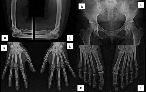 Figure 2. Radiographic assessment 9 months after renal transplantation. L, left side; R, right side.