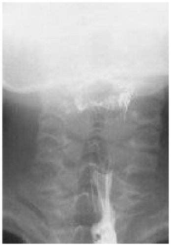 Figure 3. Postoperative contrast radiograph. There were no leakage of contrast materials.