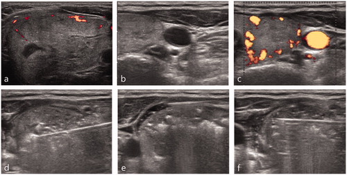 Figure 2. A 55-year-old woman who presented with a large nodule in the left thyroid gland (a). Pre-ablation US evaluation revealed a medial type middle cervical sympathetic ganglion located close to the thyroid nodule (b,c). An RF electrode with a 1 cm size active tip was used for ablation (d). During ablation, ipsilateral conjunctival injection was detected, which is one of the early symptoms of Horner syndrome. Ablation was stopped immediately and a cold dextrose solution was injected directly into the perithyroidal area (e). After injection of 7 ml of cold dextrose solution, the patient’s symptoms had completely improved (e).