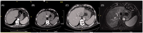 Figure 1. (A) Computed tomography axial scan post-IV contrast medium injection in arterial phase – HCC located in left hepatic lobe close to the liver hilum. (B) Computed tomography axial scan without IV contrast medium injection – tip of the microwave antenna is located at the distal end of the tumour. (C) Computed tomography axial scan post-IV contrast medium injection in portal venous phase immediately postablation – the ablation zone covers the whole tumour plus a safety margin. (D) MRI post-IV contrast medium injection in arterial phase one year postablation illustrates no viable tumour.