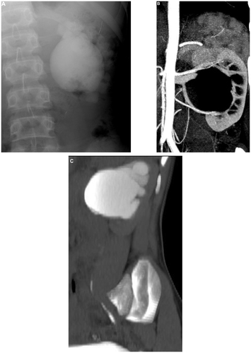 Figure 3 Left pelviureteral junction obstruction. (A) Intravenous urography shows hydronephrotic left kidney with ballooned extrarenal pelvis. (B) Computed tomography angiography shows crossing vessels at the left pelviureteral junction. (C) Sagittal reformatted computed tomography urography for the left kidney shows dilated calyces with ballooned extrarenal pelvis and narrowing at the pelviureteral junction; the left ureter is of normal caliber.
