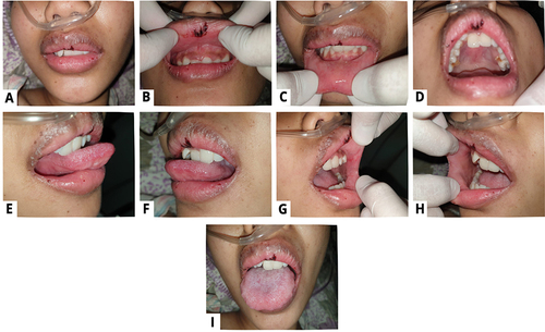 Figure 2 Overall improvements in the patient’s oral condition on the second visit (A–I).