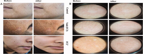 Figure 5. (A) Photographic photos of control, void, effective aspasomal cream (FC2′) before and after treatment in TVC. (B) Dermoscopic picture showed the presence of appeared clinically as hyperpigmented or hypopigmented, round to oval lesions TVC, and its disappearance after treatment indicates the efficacy of aspasomes encapsulated ITZ cream FC2.