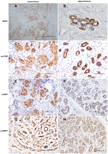 Figure 1 Immunohistochemical staining of triple-negative breast cancer (TNBC) cells and their adjacent tissues for the expression of (A and B) epidermal growth factor receptor, (C and D) phosphorylated mammalian target of rapamycin, (E and F) phosphorylated ribosomal protein S6 kinase (p-S6K1), and (G and H) phosphorylated 4E binding protein 1 (all 400 × magnification). This figure is representative of the immunohistochemistry of tumor tissues and their adjacent tissues from 48 patients with TNBC. The positive expression was determined under a microscope (×400) by the presence of clear brown granules in the membrane or cytoplasm and/or nucleus.