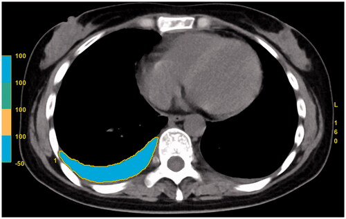 Figure 2. The measurement of pleural effusion volume with chest CT images.