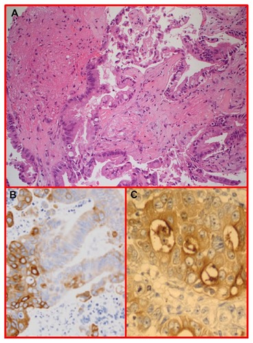 Figure 7 H&E staining of neoplastic epithelial tubules and glands infiltrating the brain parenchyma.