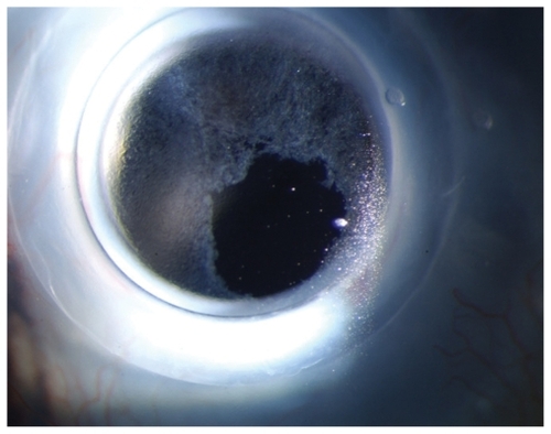 Figure 1 Slit lamp photograph of the type 1 Boston Keratoprosthesis with epithelial growth over the optic.