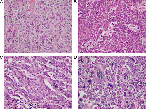 Figure 1 Typical pathological section images of Edmondson-Steiner grade. (A) Grade I. (B) Grade II. (C) Grade III. (D) Grade IV.