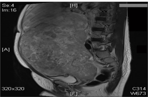 Figure 6 A 40-year-old woman with a large abdomino-pelvic mass, which turned out to be an aggressive leiomyosarcoma.