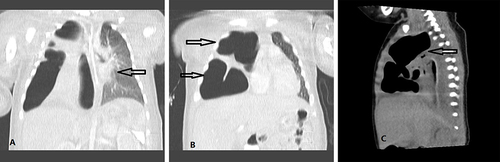 Figure 2 (A) Chest-CT Scan, the black arrow shows left lung opacification. (B) Chest-CT Scan, black arrows shows right lung cystic lesions. (C) Chest-CT Scan, the black arrow shows right lung cystic lesions.