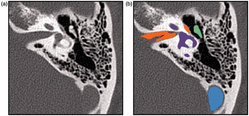 Figure. 2. A slice of a CT image of the temporal bone (a), and corresponding slices of the label volumes superimposed onto the image (b). Labels are cranial nerves in orange, inner ear in purple, ossicles in green, and sigmoid sinus in blue.