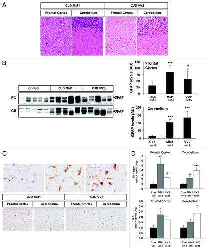 Figure 4. Subtype-specific neuropathological changes, astrogliosis and inflammation in sCJD brain samples. (A) Haematoxylin and eosin staining of sCJD MM1 and sCJD VV2 cases from frontal cortex and cerebellum showing spongiform degeneration. (B) Western blot analysis of GFAP levels in the frontal cortex and cerebellum in control, sCJD MM1 and sCJD VV2 in five representative cases reveals a marked increase in GFAP levels in disease states. Densiometric values of GFAP in all the cases analyzed by western blot: control (n = 15), sCJD MM1 (n = 15), sCJD VV2 (n = 14) illustrates the significant increase of GFAP in the frontal cortex and cerebellum in MM1 and VV2 samples. (C) CD-68 immunoreactivity reflects progressive stages of microglia activation (upper panels) and increased numbers of microglial cells in the frontal cortex and cerebellum in MM1 and VV2. (D) mRNA average expression levels of IL6 and TNF-α in the frontal cortex and cerebellum in control, sCJD MM1 and sCJD VV2 cases, as determined by specific TaqMan PCR assays. Significant increase of TNF-α values are observed in the frontal cortex and cerebellum in sCJD MM1 and sCJD VV2, whereas a significant increase in the expression of IL-6 mRNA was seen in the frontal cortex in sCJD MM1 and cerebellum in sCJD VV2. IL-6 and TNF-α mRNA are normalized using GUSβ as internal control (housekeeping). *P > 0.05; **P > 0.01; ***P > 0.001: control vs sCJD, #P > 0.05: sCJD MM1 vs VV2. AU: arbitrary units.