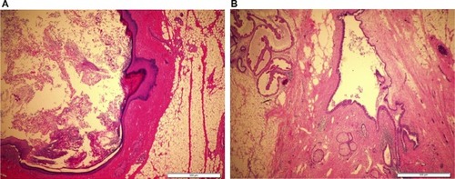 Figure 3 Histopathology of the recurrent tumor revealed heterogeneous mature elements including (A) epidermal cyst lined by mature keratinized squamous epithelium and filled with keratinous debris (H&E, 4×), (B) dermoid cyst lined by benign squamous epithelium surrounded by mature fibroadipose tissue with embedded adnexal glands (H&E, 4×).