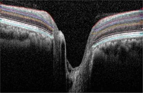 Figure 2 The retinal layers that were measured are shown.