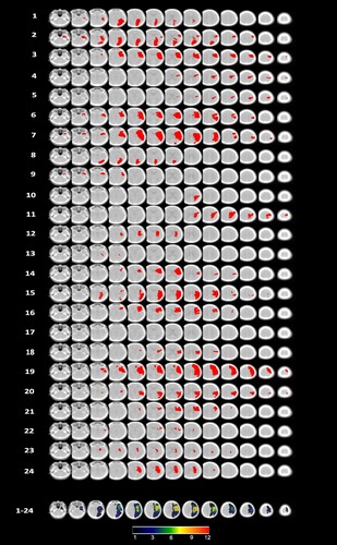 Figure 5. Lesion maps for each of the 24 individuals, projected onto 13 axial slices of the standardized older adult MNI template ((scct.nii) developed by Rorden et al., Citation2012), plus the cumulative overlap map. Orientation is per neuroscience standard with the right hemisphere on the right side in each slice.