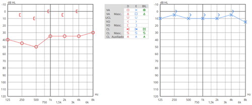 Figure 1. Pure-tone audiogram. Mild conductive hearing loss in the right ear and normal hearing in the left ear.