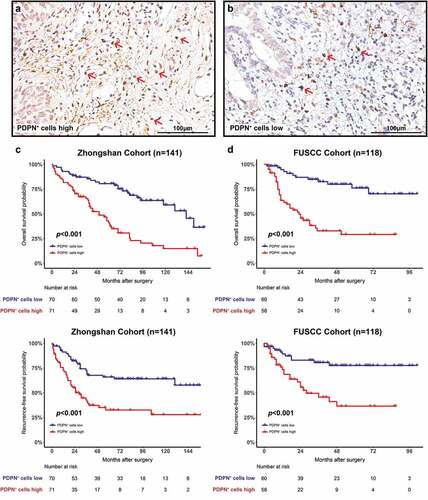 Figure 1. Prognostic significance of tumor-infiltrating PDPN+ cell abundance. Representative images of PDPN immunohistochemistry staining showing tumor-infiltrating PDPN+ cells high (a) and low (b) infiltration in MIBC. Kaplan–Meier curves for OS with PDPN+ cell infiltration strata in Zhongshan Cohort (c) and FUSCC Cohort (d). Kaplan–Meier curves for RFS with PDPN+ cell infiltration strata in Zhongshan Cohort (e) and FUSCC Cohort (f). Log-rank p values were shown
