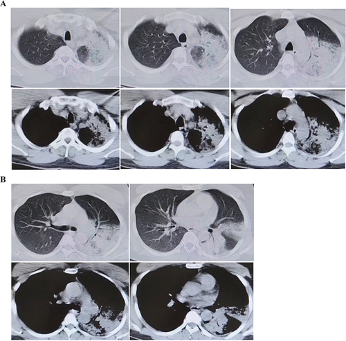 Figure 1 Chest computed tomography scans on the 0th day of hospitalization in the local hospital (A and B). CT scans showed patchy high-density shadows with blurred margins in both the posterior segment of the left upper lung and the dorsal segment of the lower lung.