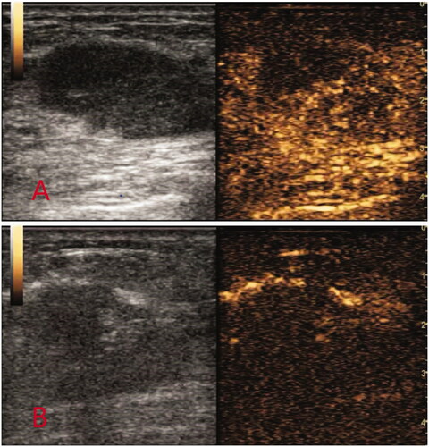 Figure 3. Contrast-enhanced ultrasound images before and after MVA. (A) Before ablation: ultrasound CEUS blood perfusion showed high enhancement. (B) After ablation: ultrasound CEUS blood perfusion showed no enhancement.