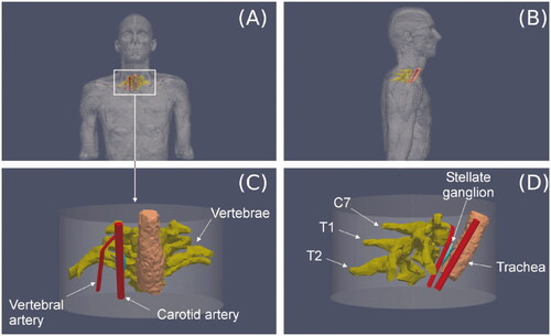 Figure 2. (A and B) 3D model based on imaging. (C and D) Cylindrical volume including the right stellate ganglion (SG) and the tissues around which were expected to be relevant in the context of the RFA due their proximity.