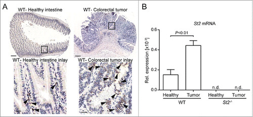 Figure 3. IL-33 and St2 expression are induced in CRC in mice. (A) IHC for IL-33 of healthy and tumor WT intestinal tissue. Scale bars: overview: 200 µm; inlay 25 µm. (B) Increased St2 transcript levels in WT tumor vs. adjacent tumor-free tissue. Data represent means ± SEM; n = 9 samples per group; n.d., non-detected. Statistical analysis was performed using paired t test.
