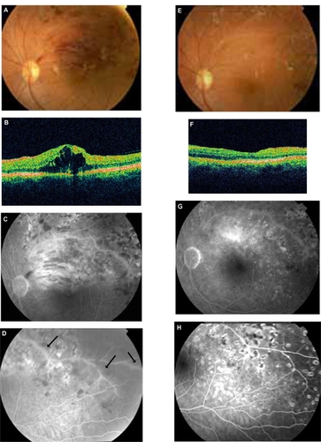Figure 2 Patient 4 (Tables 2 and 3). A, B, C, D: BRVO along with cystoid macular edema (CME) in OCT and signs of vasculitis (FA arrows) treated previously with laser and intravitreal bevacizumab (positive serology for Bartonella henselae and history of cat scratch). E, F, G, H: After 4 weeks’ treatment with azithromycin and rifampicin, there is a significant improvement of fundus findings along with FA findings and total regression of CME (OCT).