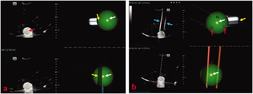Figure 3. These photographs show needle placement on phantom models guided by three-dimensional ultrasound fusion image (3DUS-FI). Real-time two-dimensional ultrasound (2DUS) images (upper left), three-dimensional ultrasound (3DUS) volume images (lower left), 3 D views of the coronal plane (upper right) and lateral (lower right) of the ball were simultaneously displayed on a screen. The green balls and bright dots (white arrows) in 3 D views were 3 D displays of the ball and its center point based on magnetic position tracking. (a) With the probe’s movement, the 3 D positional relationship between real-time 2DUS images and the ball could be directly observed in 3 D views (yellow arrows). The largest plane and the center point of the ball (red arrow) could be observed in real-time to guide needle placement by moving the probe to make real-time 2DUS images toward the center points (white arrows) in 3 D views. (b) The virtual ablation needle and the probe were linked by magnetic position tracking. With the probe’s (yellow arrow) movement, the 3 D positional relationship between virtual ablation needles (red arrows) and the ball could be observed in 3 D views. Needle positions that had been placed inside the ball (blue arrows) could real-time be saved in 3 D views (red arrows), which provided important information for multiple-needles placement.