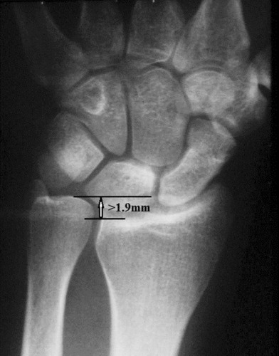 Figure 1. An Essex-Lopresti lesion was diagnosed in this patient's radiographs, which demonstrated greater than 2 mm of shortening of the ipsilateral radius when compared to the contralateral side.