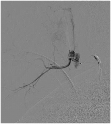 Figure 1. Digital subtraction angiography (DSA) of the left facial artery revealing active extravasation with a pseudoaneurym.