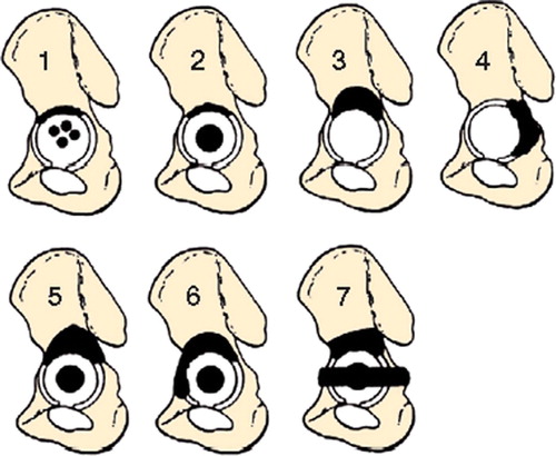 Figure 1. Defect classification according to Bettin and Katthagen (Citation1997). Type 1 is a cavity. Types 2–4 are unisegmental defects. Type 5 is bisegmental, type 6 is trisegmental, and type 7 is a discontinuity of the pelvis.