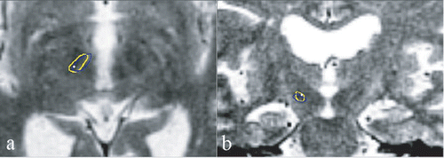 Figure 2. T2-weighted MR image of a patient demonstrating direct visualization of STN: (a) axial slice; (b) coronal slice. The contour of the segmented STN based on T1 and T2 maps is marked in yellow; that based on the digitized Schaltenbrand atlas is marked in blue. The small white sphere is the actual surgical target. The digitized atlas and T1 and T2 maps were registered to the patient brain image space. [Color version available online.]