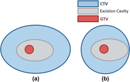 Figure 1. Schematic diagram of the boost volume in post-lumpectomy external radiotherapy, a) current approach that considers a symmetric volume to the asymmetric excision margin, as compared to b) new proposed approach with asymmetrically defined CTV to the excision cavity, suggested to reduce the boost volume in the current approach (on the left).