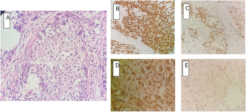 Figure 2 Histopathological staining and Immunohistochemical stain of peritoneal surface nodules. (A) hematoxylin and eosin stain. Magnification: × 200; (B–E) Immunohistochemical stain: (B) CK5/6(+); (C) HBME1(+); (D) Vim (+); (E) WT-1(1% weak +); (200X).