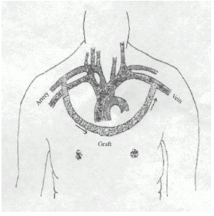 Figure 1. Anterior chest wall axillary artery to contralateral axillary vein bridge vascular access for hemodialysis.