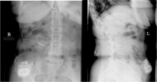 Figure 2 Anteroposterior and lateral view of a thoracolumbar spinal cord stimulation placement; the 8-pole lead (octrode) is positioned at level TH10–12, and the impulse generator is placed abdominally subcutaneously.