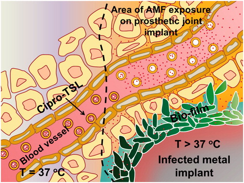 Figure 1. Schematic of ciprofloxacin release from temperature sensitive liposomes (TSL) in the vicinity of an infected metal implant heated by exposure to alternating magnetic field (AMF).
