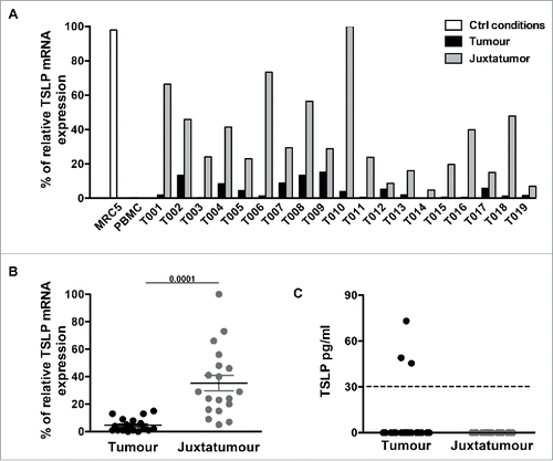 Figure 3. TSLP mRNA expression is higher in juxta-tumor tissue than breast cancer tissue. (A) TSLP transcripts were measured by quantitative PCR (TaqMan) in 19 breast cancer tissues (black bars) and 19 corresponding juxta-tumor tissues (gray bars). White bars represent TSLP levels detected in MRC5 and PBMC used as positive and negative control respectively. (B) Quantification of TSLP mRNA transcripts shown as percentage of housekeeping gene expression. Four housekeeping genes were used for these experiments: Actin Beta (ACTB), Hypoxanthine Phosphoribosyltransferase 1 (HPRT1), Ribosomal Protein L31 (RPL31) and Beta-2-Microglobulin (B2M). Lines represent mean +/− the Standard Error of the Mean (SEM). Wilcoxon matched pairs test was used to calculate p value. N = 19. (C) Quantification of soluble TSLP measured by ELISA in the supernatants generated from primary breast tumor tissues and corresponding juxta-tumor samples as described in the Material and Methods section. ELISA sensitivity detection limit, which is represented by the dashed line, was 31 pg/mL as recommended by the manufacturer instructions. N = 40.